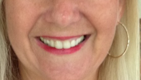 Teeth for blog